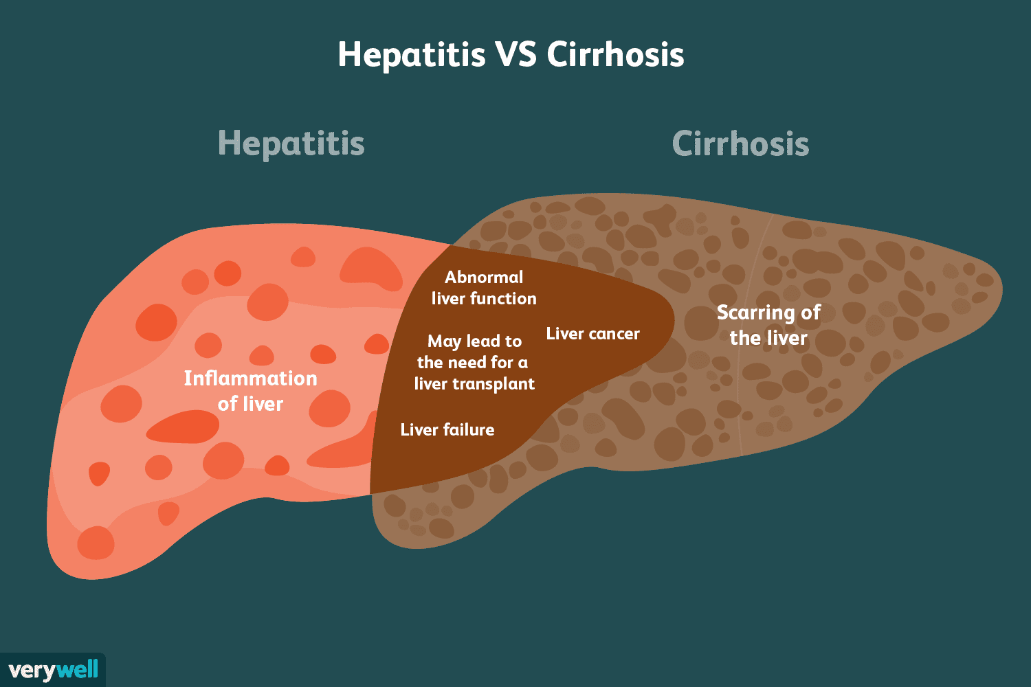 Can Viral Infections Like Hepatitis Cause Long-Term Liver Damage Can Viral Infections Like Hepatitis Cause Long-Term Liver Damage