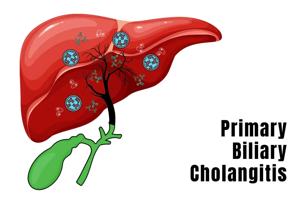 Living with Primary Biliary Cholangitis