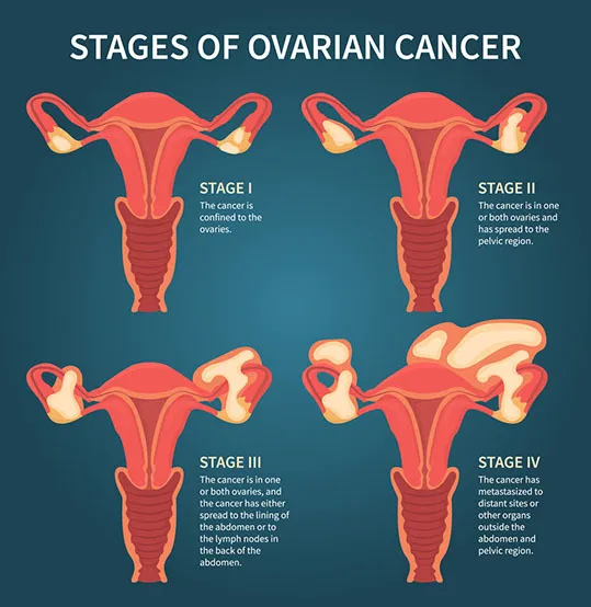 Preguntas y respuestas relacionadas con el cáncer ovárico recurrente