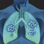 Why Is Lung Cancer Research Underfunded?