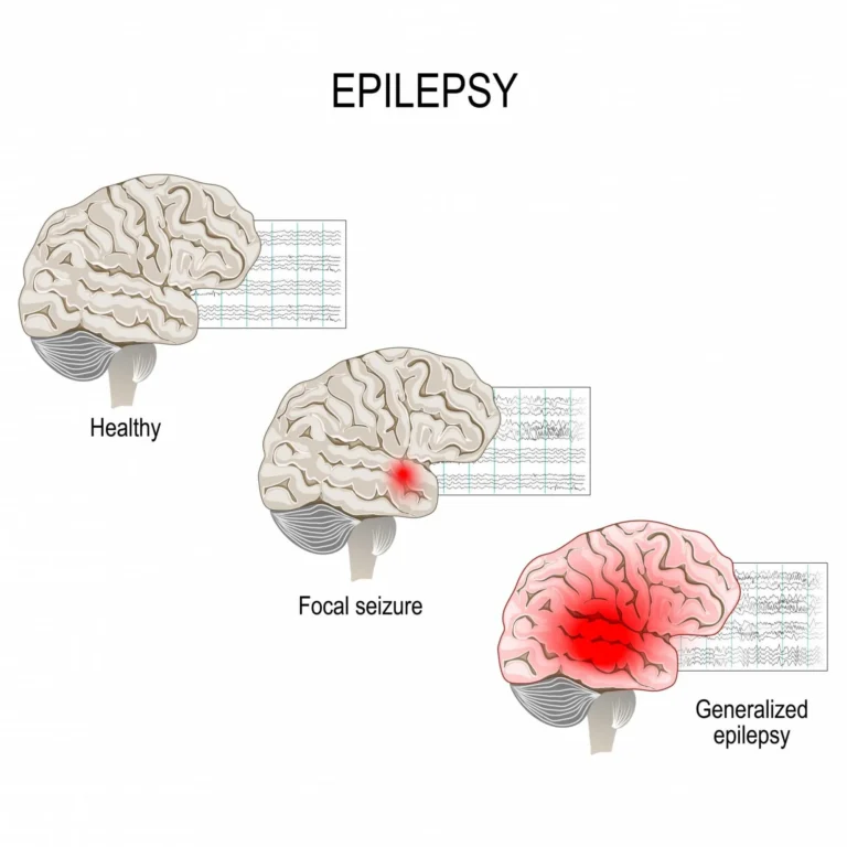 The Science Behind Keto and Epilepsy: How It Works to Reduce Seizures