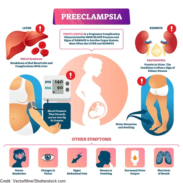 Indicators Of Preeclampsia – Healthywomen Indicators Of Preeclampsia – Healthywomen