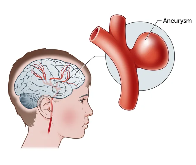 More than one Mind Aneurysms Modified My Past