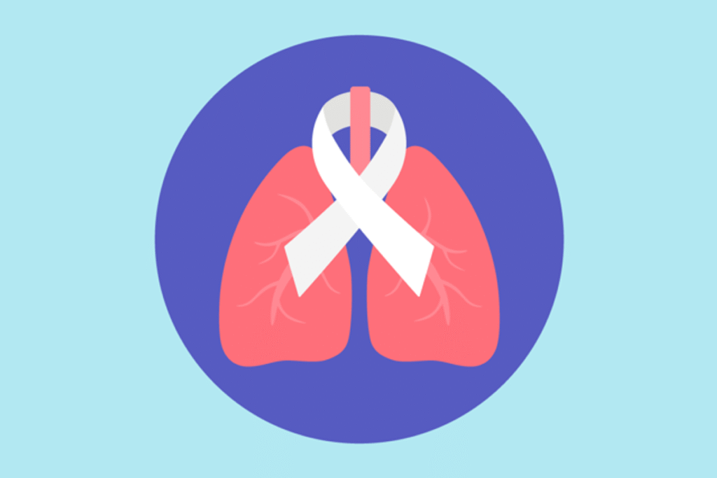 Síntomas de cáncer pulmonar Síntomas de cáncer pulmonar