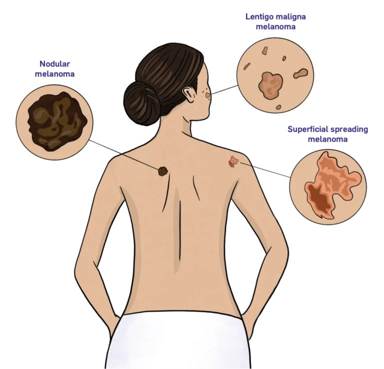 Varieties of Melanoma – HealthyWomen