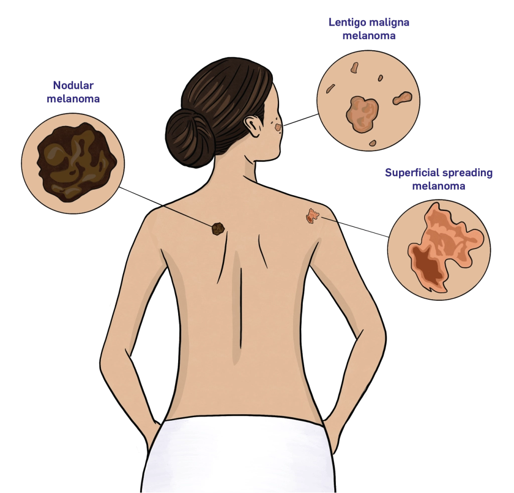Varieties of Melanoma – HealthyWomen