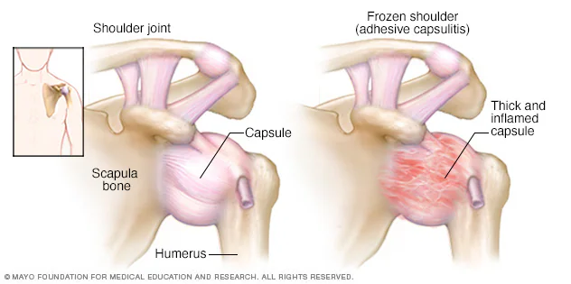 Diagram showing normal shoulder and frozen shoulder joint capsule
